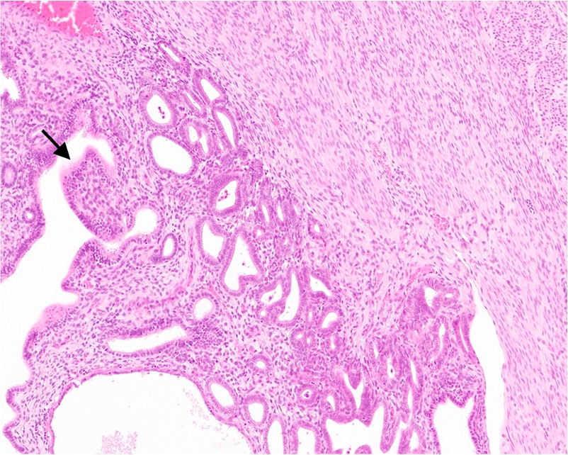 Figure 1a - Papillary Subtype