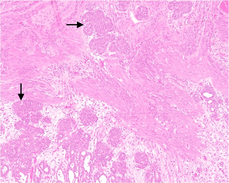 Figure 1b - Tubular/Solid Subtype