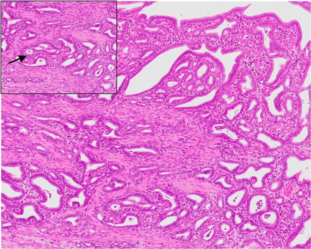 Figure 2b - Grade 2