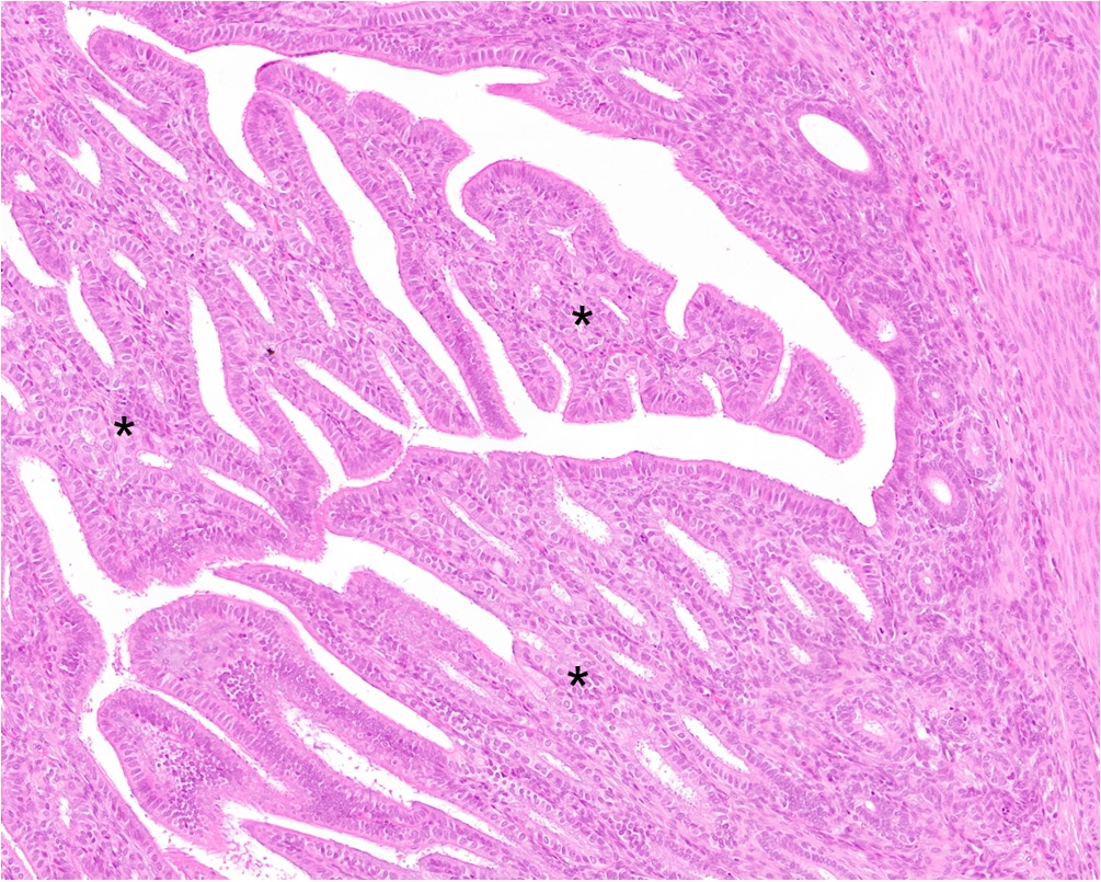 Figure 3b - Endometrial Hyperplasia